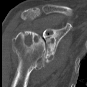 CT TSR Preop Glenoid Cysts